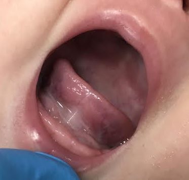 no frenulum tongue